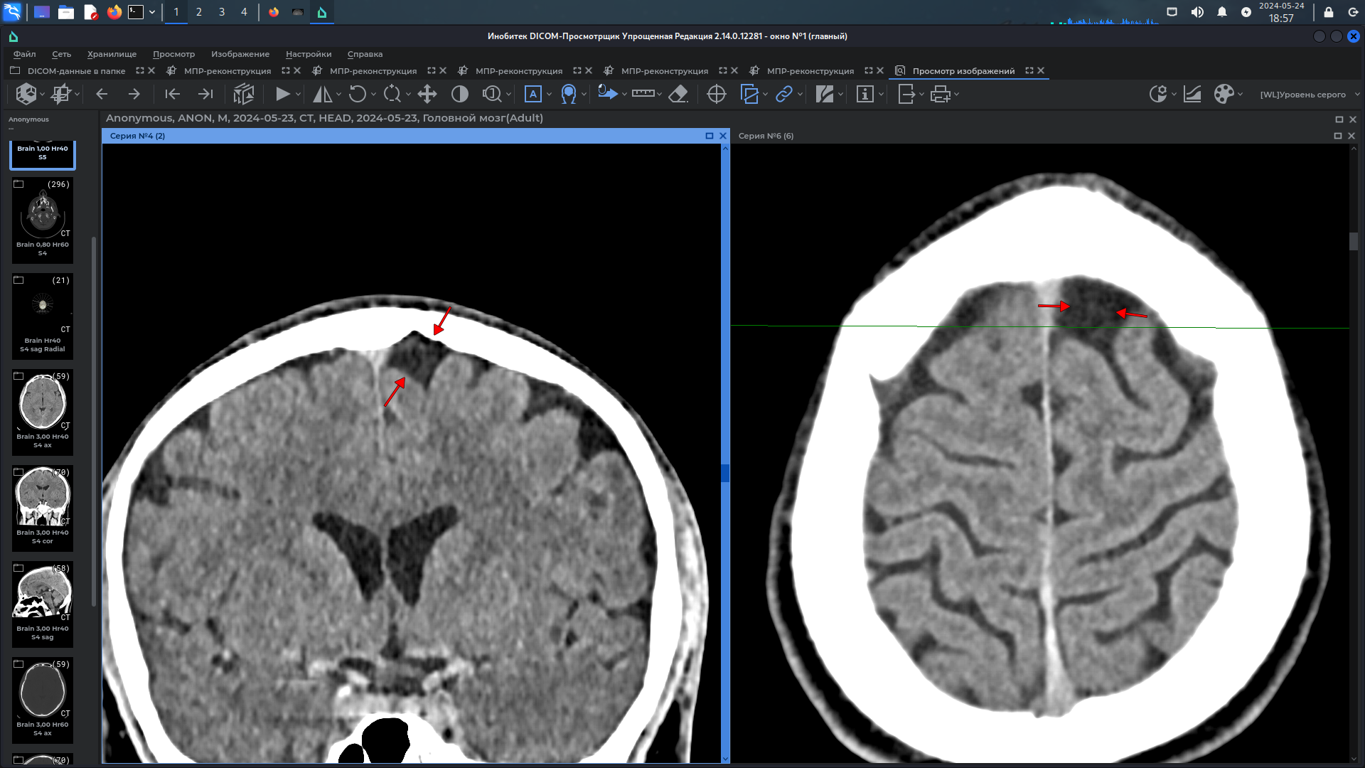 Illegal implant CT